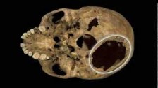 Richard III - Injuries to the Remains