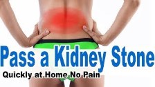 How To Pass Kidney Stones